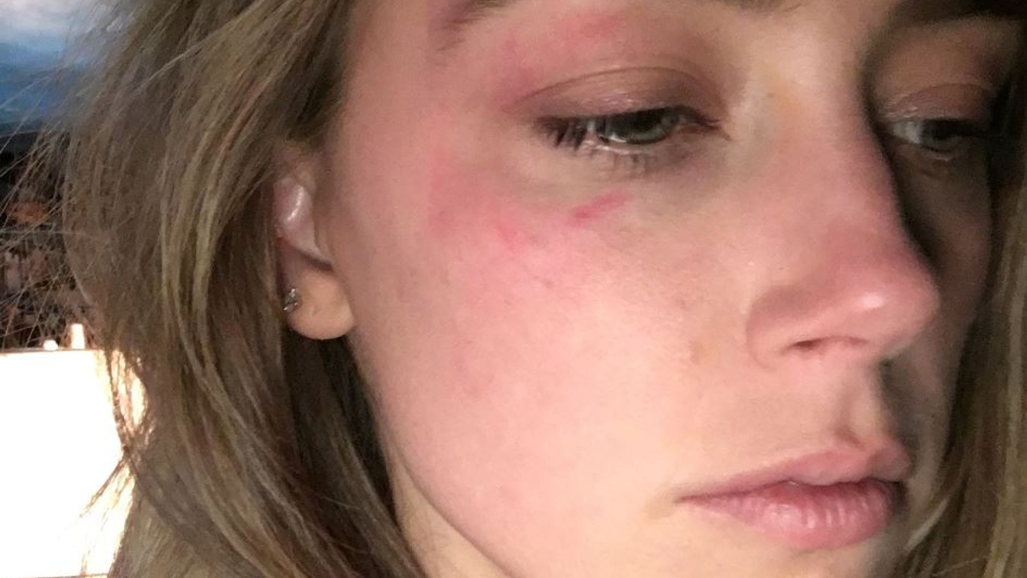 Amber Heard - Facial Injuries